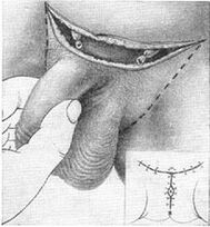 Surgical lengthening of the penis by tearing off its hidden part
